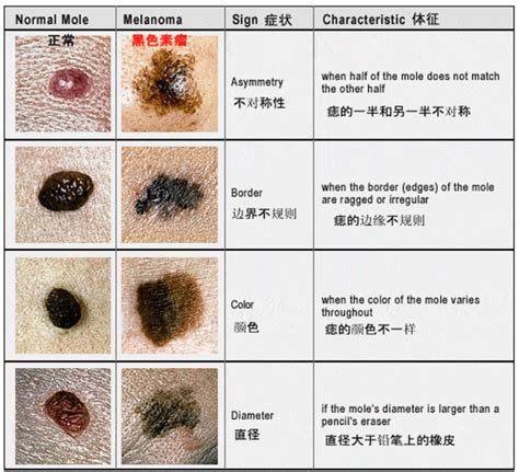 身上有痣|痣也可能会癌变！长在 3 个地方要注意